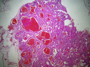Imagen histológica de hemangioma capilar de glándula parótida.