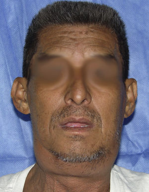 Vista frontal donde se observa un aumento del volumen severo con predominio de la región submentoniana y submandibular bilateral.