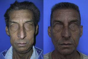 La imagen de la izquierda corresponde a la vista frontal posterior al alta médica y la de la derecha corresponde a un año de control donde se observa una simetría facial sin aumento del volumen en la región.