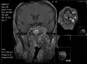 Axial and coronal plane demonstrating an expansive lesion centered in the left parapharyngeal, infra-temporal and mastigator spaces, with considerable intracranial invasion.