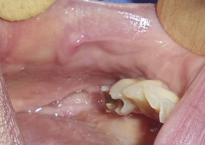 Lesión tumoral de 15mm de diámetro de color similar a la mucosa oral y de superficie lisa. Se ubica en la mucosa oral izquierda.