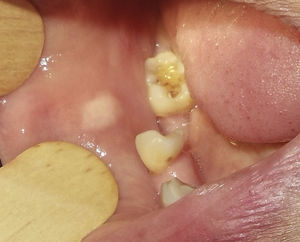 Lesión tumoral de 10mm de diámetro, hipocrómica y de superficie lisa. Se ubica en la mucosa oral derecha.