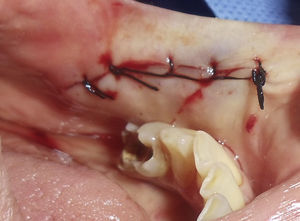 Cierre quirúrgico en el área donde se realizó la escisión quirúrgica en la mucosa oral izquierda.