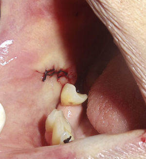 Cierre quirúrgico en el área donde se realizó la escisión quirúrgica en la mucosa oral derecha.
