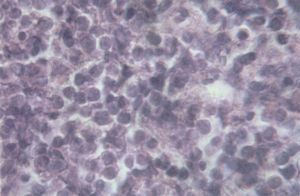 Examen histopatológico de la biopsia de la lesión gingival mostrando una proliferación de células linfoides atípicas de mediano y gran tamaño, con núcleos regulares, cromatina laxa, presencia de nucléolos adosados a la membrana celular y citoplasma anfófilo. Giemsa 40X.