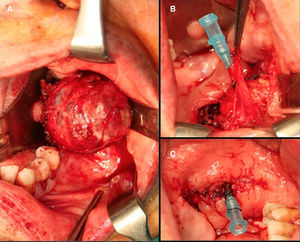 Sección del conducto y fijación del segmento remanente a mucosa yugal.