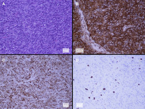 Imágenes histológicas compatibles con tumor fibroso solitario.