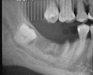 Necrosis ósea postexodoncia de 4.6 y 4.7 estimulado por toillete excesiva.