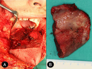 A) Imagen intraoperatoria de la resección. Se puede apreciar el importante defecto creado tras la glosectomía subtotal, así como el abordaje realizado a través de queilotomía y mandibulotomía medias. B) Pieza quirúrgica de glosectomía.