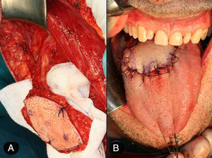 A) Imagen de la disección del colgajo fasciocutáneo anterolateral de muslo. B) Colgajo libre anterolateral de muslo adaptado sobre el defecto posglosectomía.