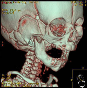 TAC 3D de paciente con síndrome de Treacher-Collins.