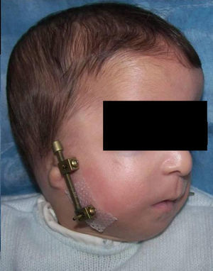 Paciente con síndrome de Treacher-Collins sin cánula de traqueotomía y en periodo de contención tras distracción mandibular.