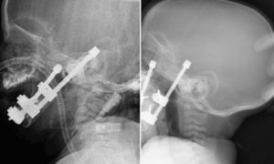 Izquierda: Radiografía lateral de cráneo pretratamiento mediante distracción ósea. Derecha: Radiografía lateral de cráneo posdistracción ósea.