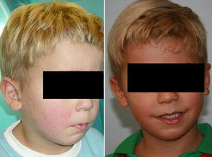 Izquierda: Paciente de la figura 3 con 3 años. Derecha: Paciente de la figura 3 con 5 años.