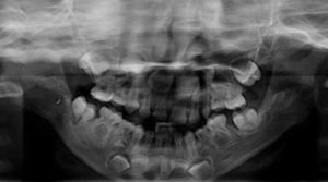 Ortopantomografía de paciente de la figura 3 con 5 años. Véase la rama y el cuerpo elongados, escotadura antegonial corregida y poca definición de los ángulos mandibulares.
