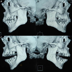 A y B) Tomografías con la boca cerrada. C y D) Tomografías con la boca abierta. Se observa que los procesos coronoideos chocan con la cara posterior del hueso malar.