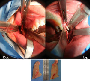 Imágenes transoperatorias y especímenes retirados en el procedimiento quirúrgico.