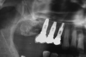 X-ray image after prosthesis loading.