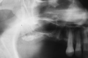 Pre-surgical atrophic maxillary sinus.