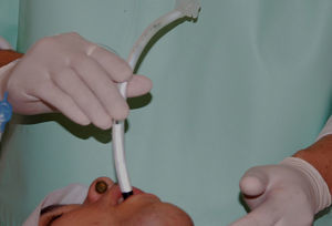 Procedimiento de intubación clásica.