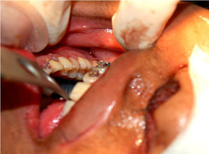 Vista de la región intraoral donde puede apreciarse el tubo pasando por la abertura del túnel orosubmental a través de una incisión en la región premolar.