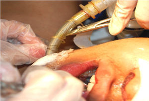 Tubo endotraqueal después de ser pasado por el túnel orosubmental. El mismo es fijado en posición con suturas de nailon.