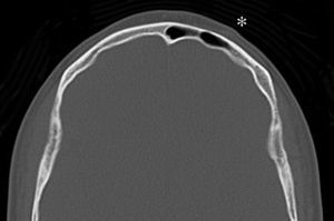 Imagen axial de la TC sin evidencia de hallazgos patológicos significativos en la calota craneal. Asterisco: se visualiza un aumento de los tejidos blandos en la región frontal izquierda de aspecto nodular.