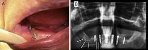 A) Exposición ósea y supuración periimplantar. B) Ortopantomografía: Lesiones osteolíticas en cuerpo mandibular derecho y área periimplantar.