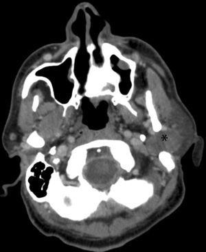 Tomografía computarizada con contraste. Se aprecia la tumoración (*) en la región parotídea izquierda.