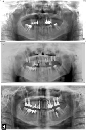 a) Caso número 6: radiografía preoperatoria que muestra lesión periapical quística a nivel del incisivo lateral superior derecho. Se realizó exodoncia del diente 12 y legrado del área apical con buena cicatrización. b) Vuelve a aparecer el área periapical después de la inserción del implante que presenta buena estabilidad; se realizó curetaje. c) Resultado final después de cirugía periapical asociada con relleno óseo.