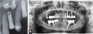 a) Caso número 9: lesión tipo implant to tooth que ha sido favorecida por la curvatura radicular del diente adyacente. La presencia de la miniplaca se debe a una cirugía ortognática previa (osteotomía maxilar). b) Caso número 10: después de la inserción implantaría, el canino superior izquierdo ha perdido la vitalidad pulpar. Se realizó la endodoncia y la radiotransparencia inicial desapareció durante el seguimiento. No se ha realizado cirugía periapical porque la paciente no tuvo síntomas.