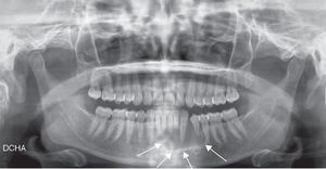 Mixed radiolucent–radiopaque unilocular lesion, encompassing the roots from 42 to 35.
