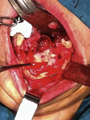 Aggressive local resection: marginal mandibulectomy without loss of the continuity of the jaw.