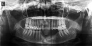 Panoramic radiography did not show recurrence two years later.