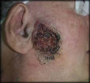 Carcinoma basocelular en región preauricular.