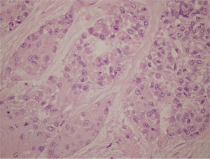 Hematoxilina-eosina (4×): nidos de células plasmocitoides y epitelioides con núcleos atípicos.