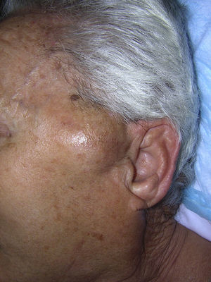 Tumoración temporal izquierda.