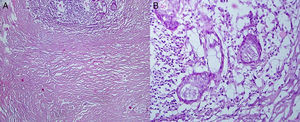 The microscopic study reveal a parotid gland tissue with periductal inflammation and fibrosis with intraluminal cellular debris and polymorphic nuclear cells. This glandular parenchyma appears in continuity with a dense-hyaline connective tissue with undefined borders that forms a sclerosing-hyaline stroma mass with inflammatory cells and interposed myoepithelial elements. (H&E; original magnification, 10×: A). A microscopic image with more detail reveals there is no presence of nuclear atypia of the ductal and squamous epithelium (H&E; original magnification, 100×: B).