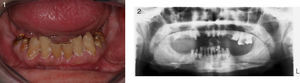 Se observó la situación actual y radiografía panorámica de un paciente (42 años) con afección periodontal avanzada del adulto en el maxilar inferior y movilidad grado 2 de los incisivos centrales y laterales. También se observaron afecciones periapicales y periodontales.