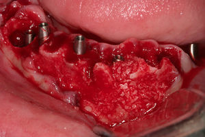 Enucleación del quiste periapical y curetaje del defecto. Implante postextracción en el defecto y rellenado con hueso en bloque corticoesponjoso particulado.