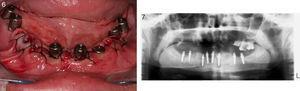 Fotografía y radiografía panorámica de la rehabilitación del maxilar inferior con 8 implantes MRT.