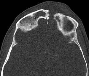 TC en la que se observa erosión de la tabla externa e interna del seno frontal..