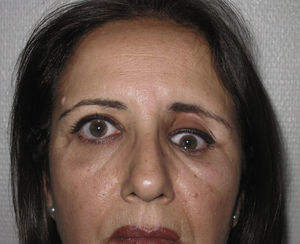 Mujer de 47 años que había sufrido un traumatismo facial 3 meses antes. Se aprecia un enoftalmos e hipoftalmos izquierdo. No tenía restricciones en la movilidad ocular.