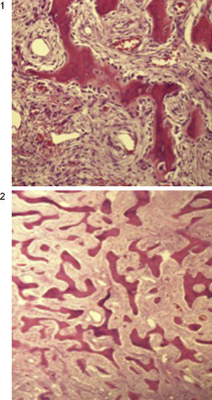 A y B) Imágenes histológicas del fibroma osificante.