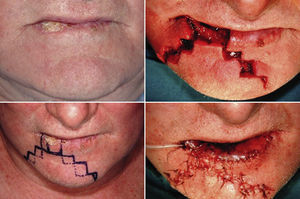 Staircase flap, bilateral asymmetric and lip-shaving: T2 lesion, preoperative planning. Excision, flap mobilization and suture.