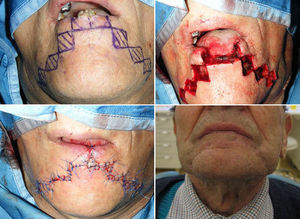 Staircase flap, median, symmetric: T2 lesion, preoperative planning, excision and suture.
