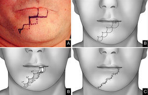 Wave flap design and preoperative planning. (A) Defect. (B–D) Flap shape and mobilization.