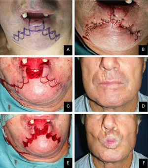 Wave flap. A clinical case. (A) Lesion dimension and position and flap design. (B and C) Excision. (D) Suture. (E and F) Resulting scar 1 year after surgery.