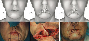 Synergistic use of Abbé and staircase flap. (A) Preoperative planning for the Sabattini-Abbe¿ flap on the medial part of the upper lip and bilateral symmetrical staircase flaps in the inferior lip: scheme and clinical case. (B) The Sabattini-Abbe¿ flap is totally incised on the side away from the pedicle and rotated into the lip defect; the staircase flaps are incised: scheme, note preservation of muscle layer, and clinical case. (C) The staircase flaps are advanced and approximated to the Sabattini-Abbe¿ flap, and sutures are placed: scheme and clinical case.