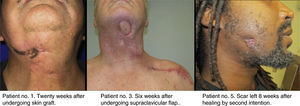 Examples of the outcome of surgical treatment in patients 1, 3 and 5.